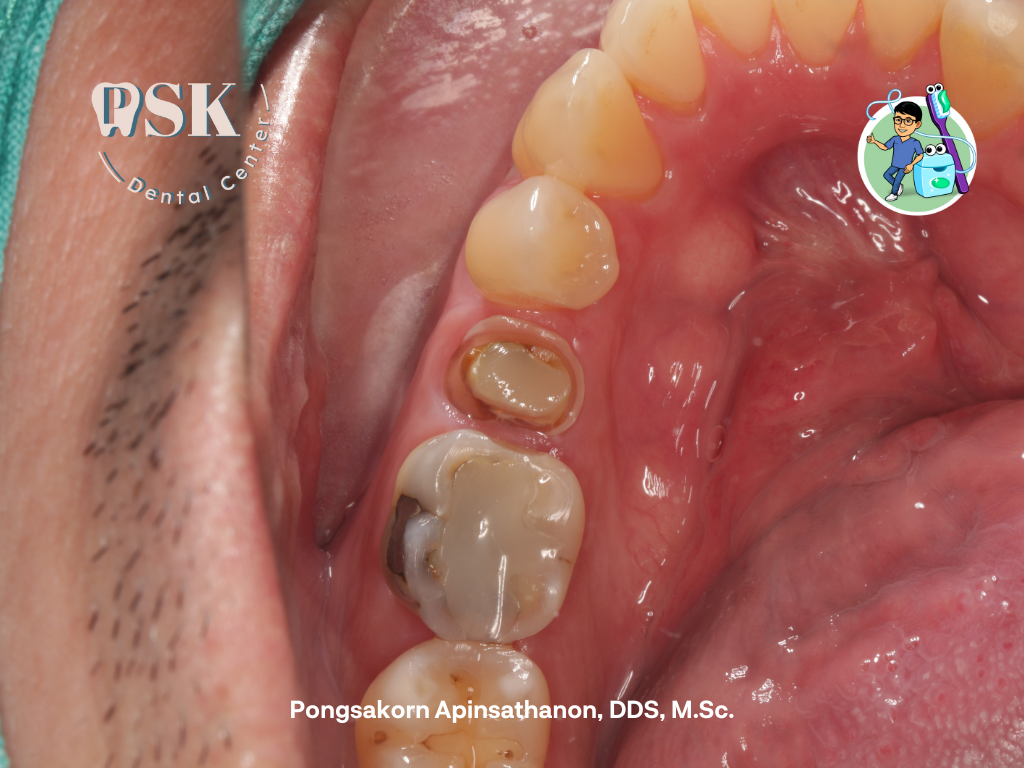 ครอบฟันชั่วคราว โดยหมอไกด์ ทพ.พงศกร อภิญสถานนท์ ครอบฟัน สะพานฟัน ครอบฟันบนฟันแท้ ที่คลินิกทันตกรรมพีเอสเค PSK Dental Center ศูนย์ทันตกรรมพีเอสเค