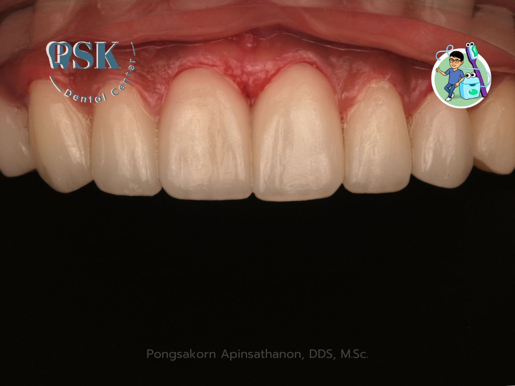 รูปภาพฟันหลังทำเซรามิกวีเนียร์ แสดงสภาพของฟันหลังการรักษา