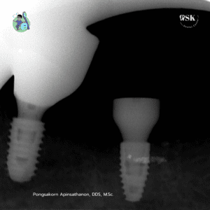 รากฟันเทียม รากเทียมสวิต Straumann กับหมอไกด์ ที่คลินิกทันตกรรมพีเอสเค หมอไกด​์รากฟันเทียม