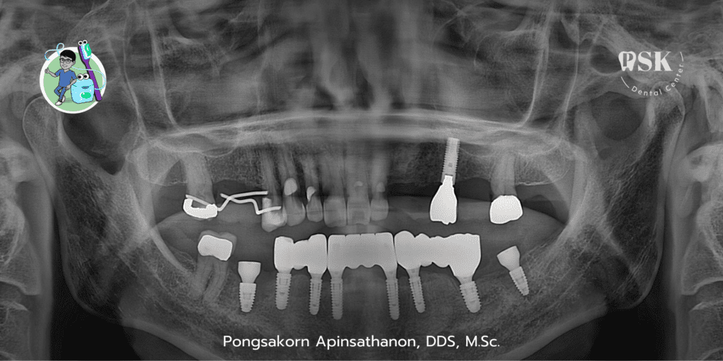 รากเทียม รากฟันเทียม ที่คลินิกทันตกรรมพีเอสเค PSK Dental Center ทำรากเทียมไม่เจ็บ รากเทียมราคาคนไทย รากเทียมราคาถูก รากเทียมคุณภาพ